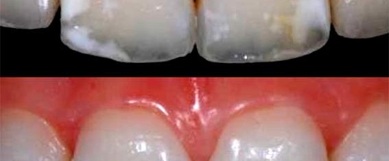 8 cosas que debemos saber del blanqueamiento
