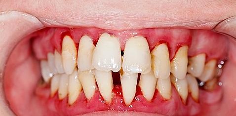 Las personas con periodontitis tienen un riesgo mucho mayor de cáncer de páncreas