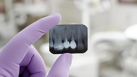 Implantes dentales ¿Son todos Iguales?