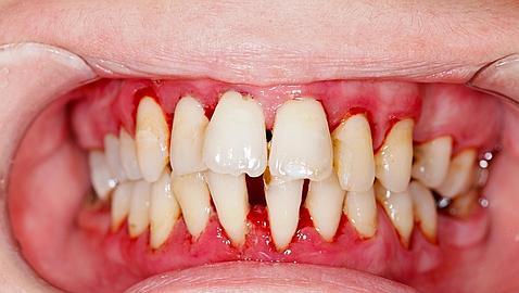 La periodontitis severa acorta la esperanza de vida