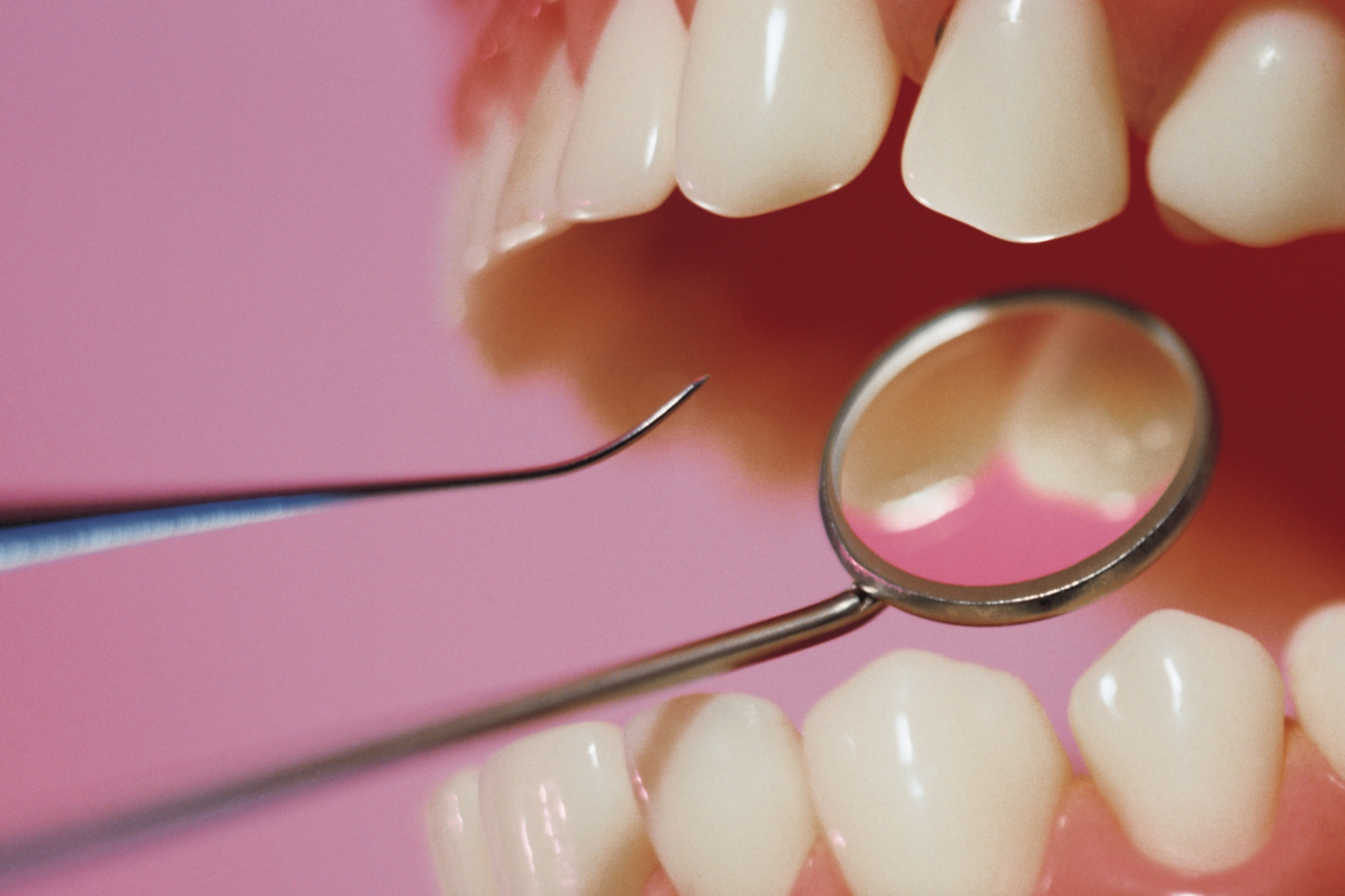 Una persona con periodontitis tiene mas riesgo de sufrir un ictus