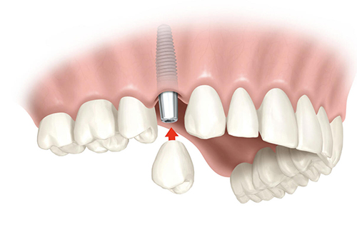 implantes dentales en Priego de Córdoba