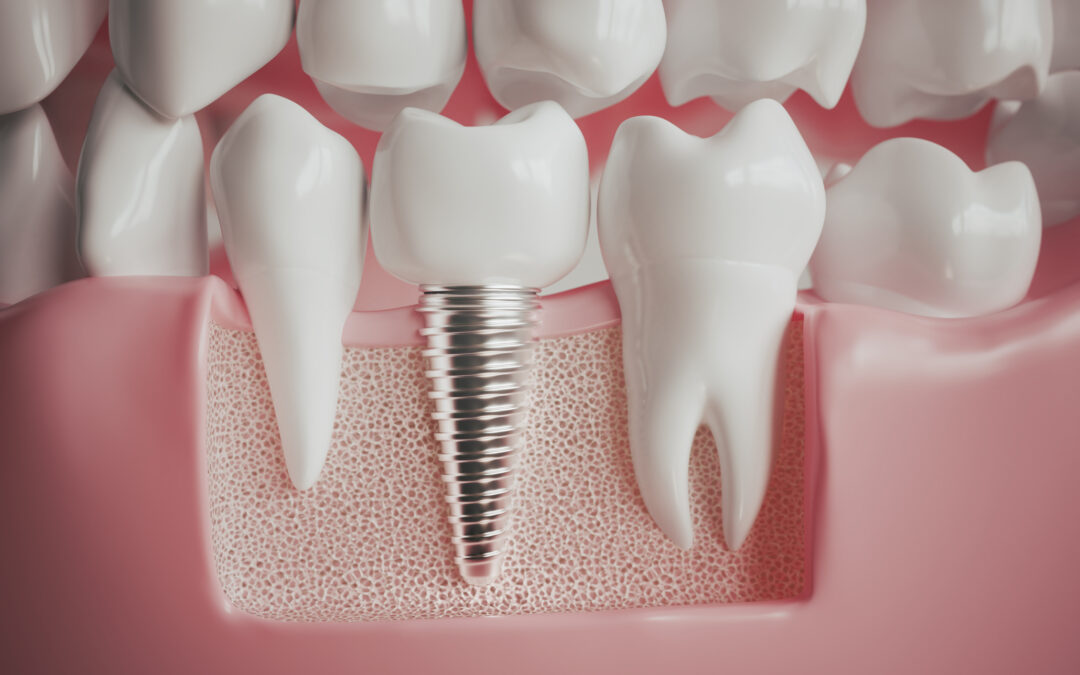 Implantes dentales con cirugía guiada: descubre sus ventajas